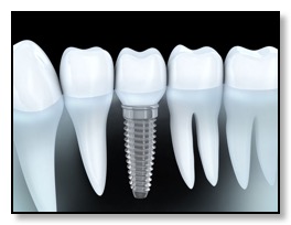 Implant placement and healing diagram